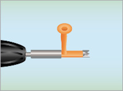 Illustration av kirurgiskt instrument med ett orange handtag och rörliga delar mot en ljusblå bakgrund.